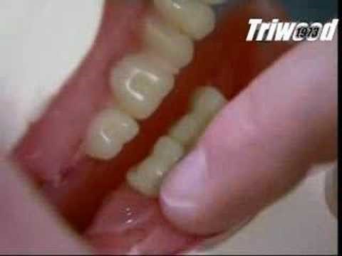 Types Of Partial Dentures Stroh IN 46789